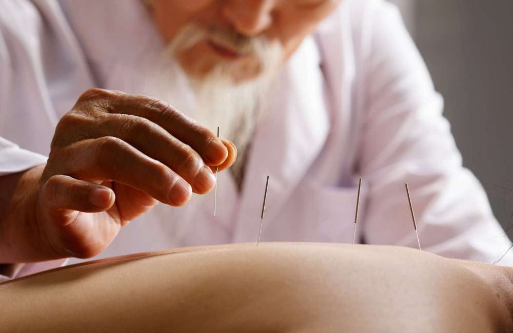 acupuncture